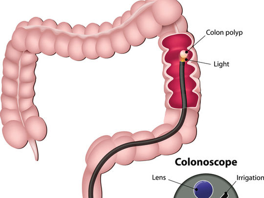 A quoi sert une coloscopie ?