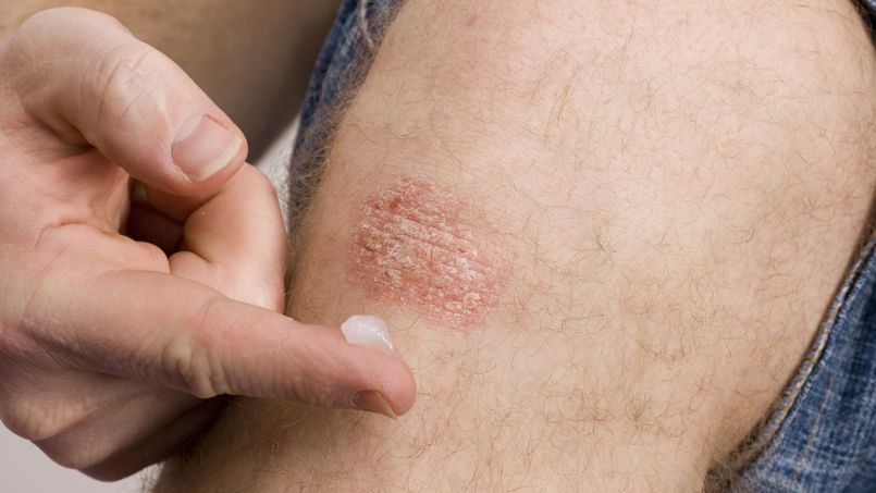 Les crèmes contre le psoriasis sont elles efficaces?